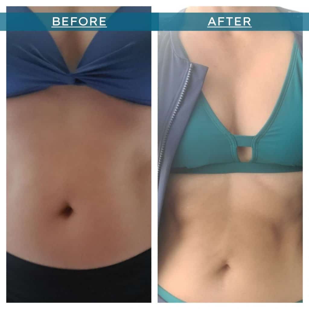 emsculpt-before-and-after-1-1-1024x1024-1.jpg