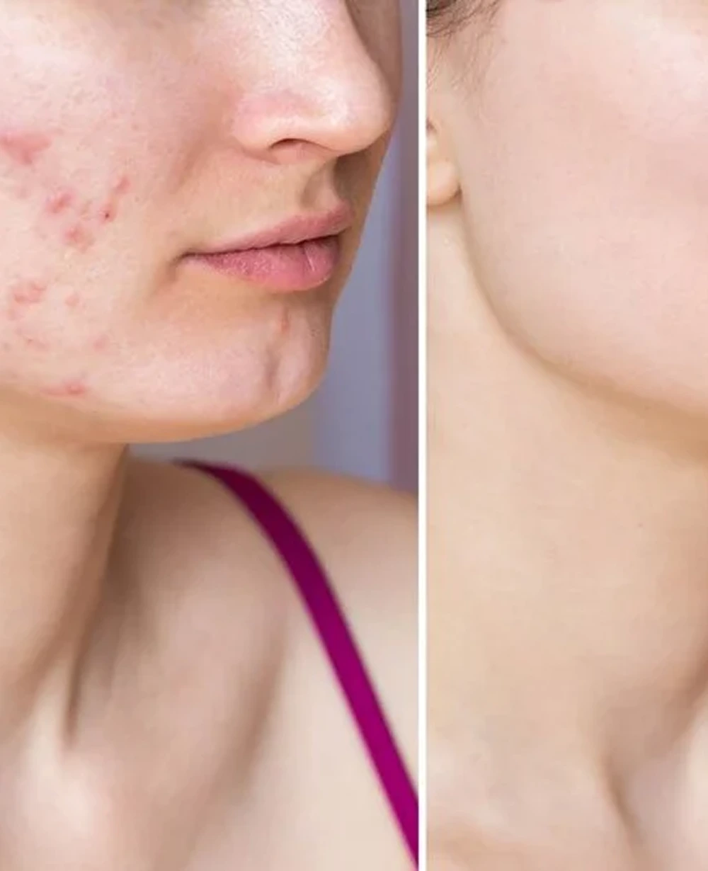 cropped-shot-young-woman-s-face-before-after-acne-treatment-face-problem-skin-health-care